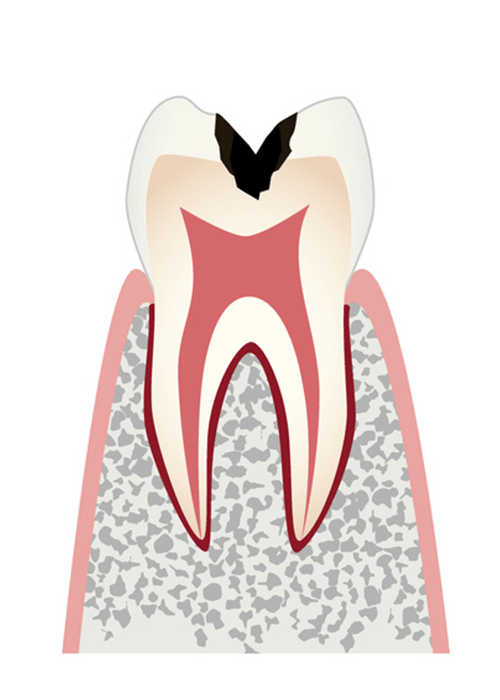 C2歯の内部まで進行したむし歯