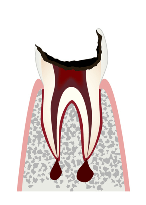 C4歯冠が大きく失われた歯